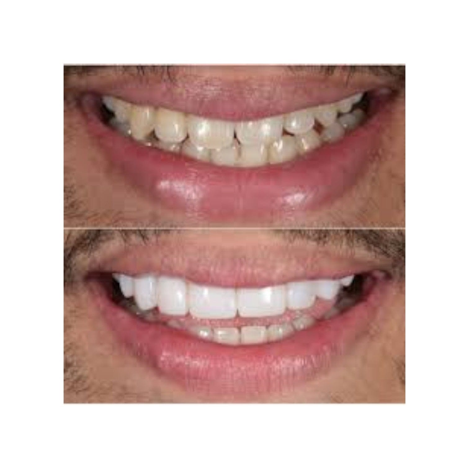 Ultimate Composite Bonding Full Smile Makeover