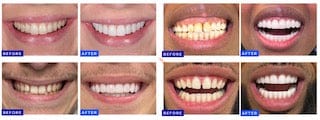Ultimate Composite Bonding Full Smile Makeover